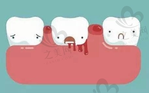 牙龈增生