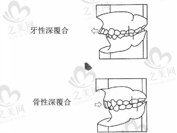 深覆合