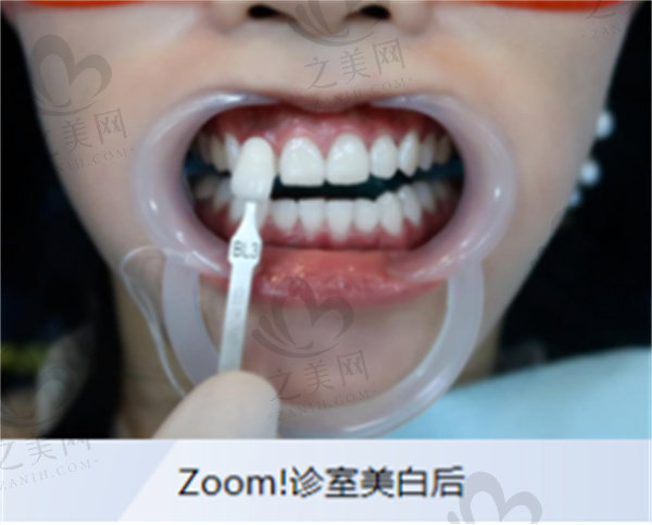 飞利浦zoom牙齿美白原理是啥？