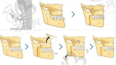 骨性反颌的矫正2