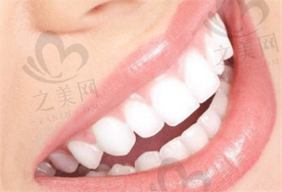 牙齿铸瓷贴面和陶瓷贴面有什么区别
