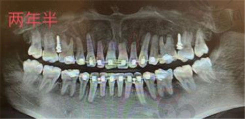 牙齿矫正后牙根状态