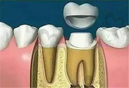 牙冠修复