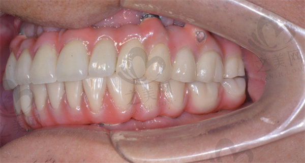牙齿缺失一直不种有什么后果？