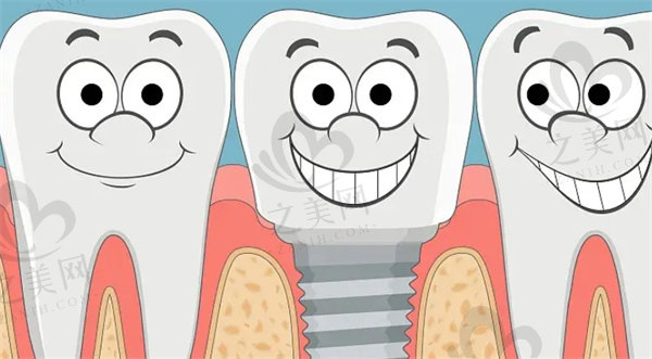 韩国种植牙和德国种植牙的区别在哪里?