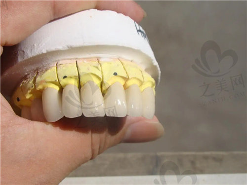 牙齿轻微断裂可以做烤瓷牙