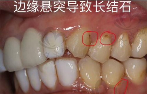 树脂贴面导致牙结石