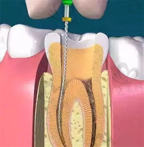 清理牙髓