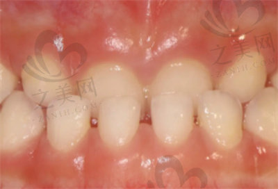 如何判断反颌是骨性还是牙性？