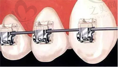 牙性反颌的矫正