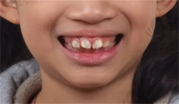牙齿矫正越早越好吗？