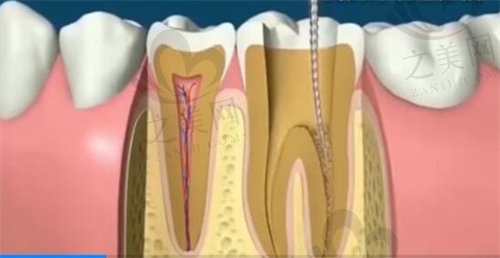 根管治疗清牙髓