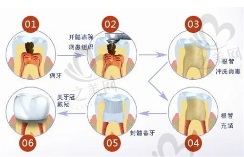 牙齿根管程序