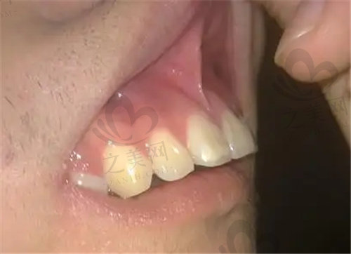 龅牙矫正可以改善凸嘴吗