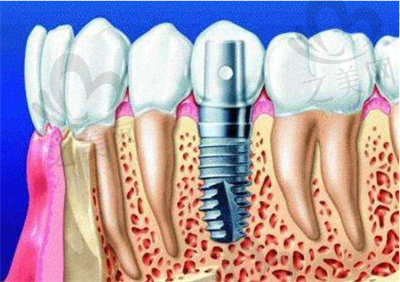 种植牙断裂修复办法1
