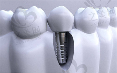 修复左上侧切牙断裂的种植牙的费用1