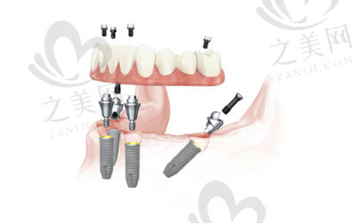 半口种植牙修复的优缺点