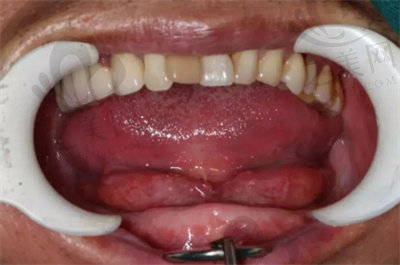 半口牙缺失