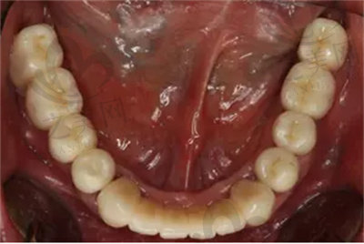 半口牙缺失的危害2
