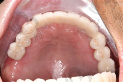 半口牙缺失的修复方式