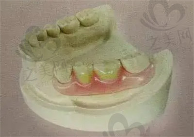 半口义齿修复的优缺点
