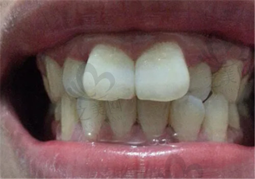 矫正门牙的方法有哪几种