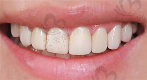 牙齿上有白点怎么处理才能恢复好