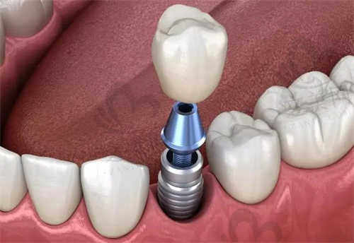 柳州中瑞口腔医院种植牙
