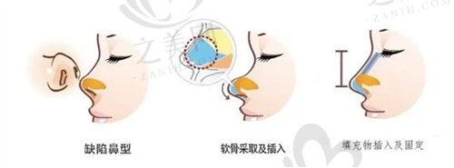 天津联合丽格第三医疗美容医院鼻部整形价格