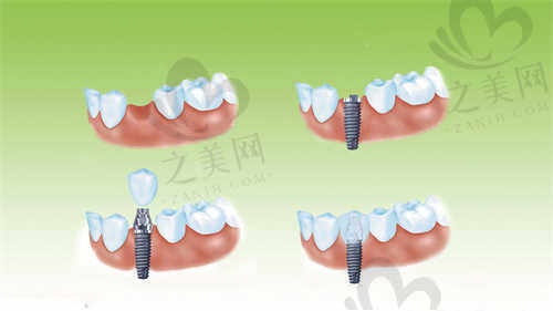 衡水可恩口腔医院种植牙过程