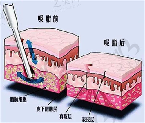 宁夏华美整形医院吸脂怎么样