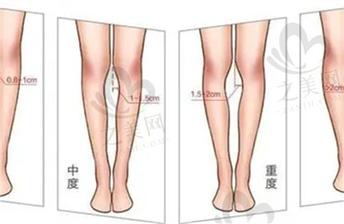 北京知音医疗美容做o型腿矫正手术怎么样