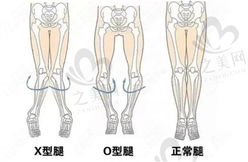 北京知音医疗美容做o型腿矫正手术怎么样