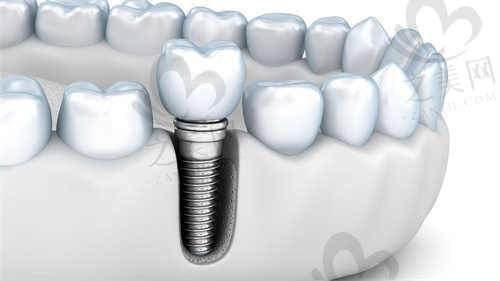 萍乡牙佰年口腔医院种植牙
