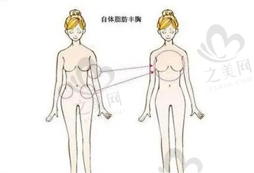 北京艺星医疗美容医院做自体脂肪隆胸怎么样？