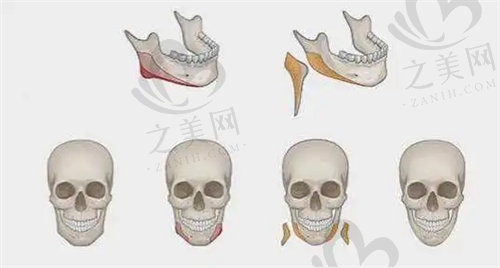 上海时光整形磨骨医生