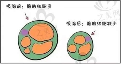 北京润美玉之光医院自体脂肪移植和吸脂价格