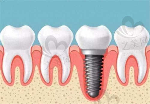 长春传阳口腔医院种植牙