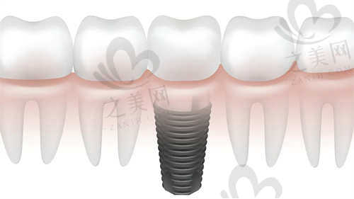 长沙雅尔口腔医院种植牙