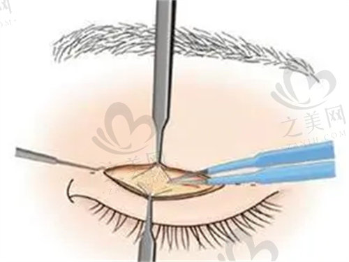 中山爱汇星整形医院双眼皮手术怎么样