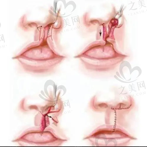 国内修复唇裂医院排名