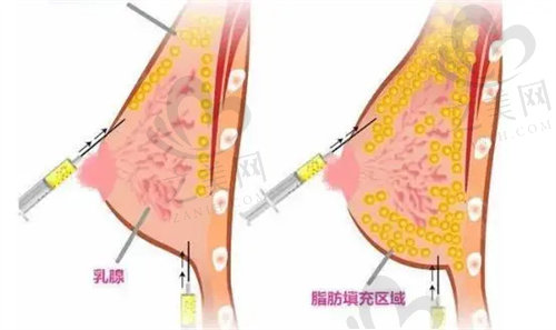 王明利医生做脂肪填充怎么样