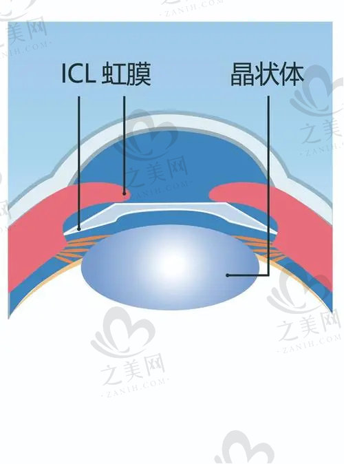 杭州柠盟眼科医院晶体植入多少钱