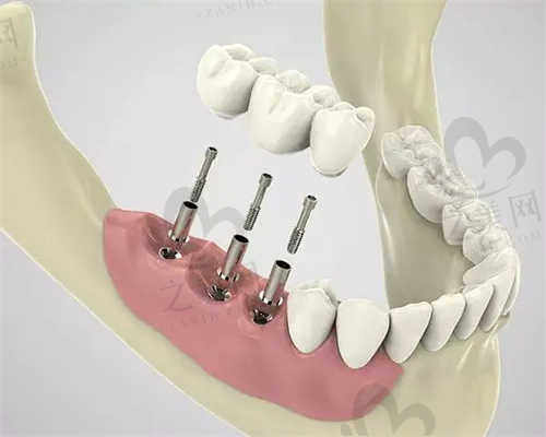 芜湖壹加壹口腔医院种植牙