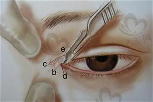 外眼角开太大了怎么办