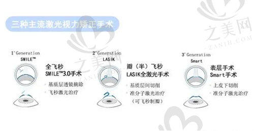 兰州普瑞眼科医院做近视眼手术多少钱