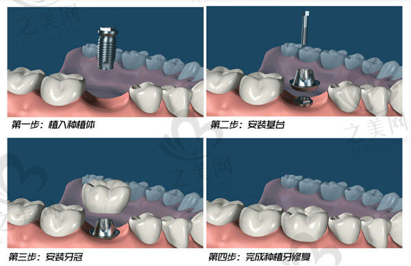 阳泉康贝齿科热门业务价格