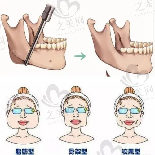 穆雄铮磨骨技术怎么样