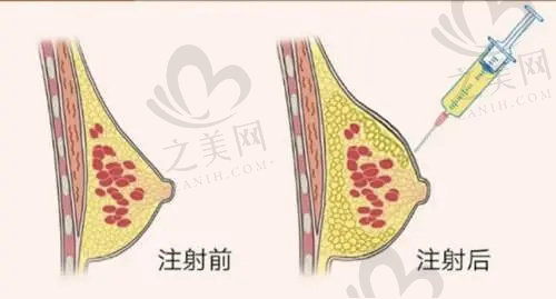 中山美南华美容医院自体脂肪填充价格