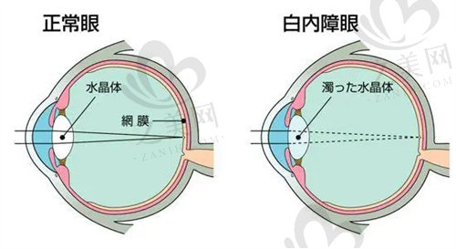 白内障